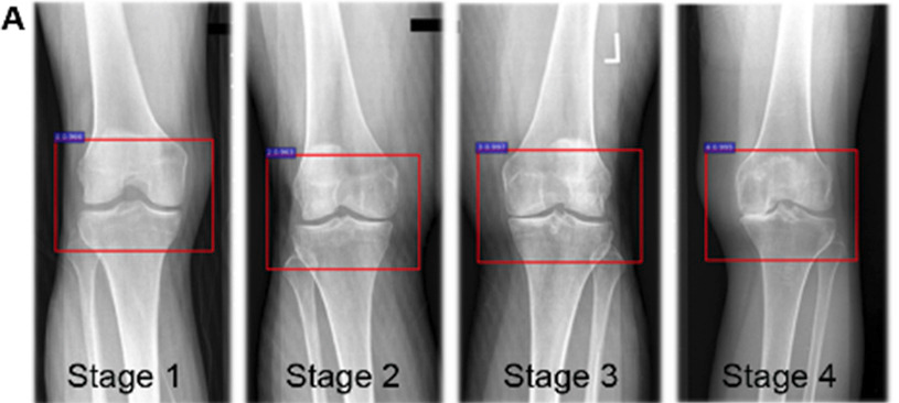 Knee Osteoarthritis